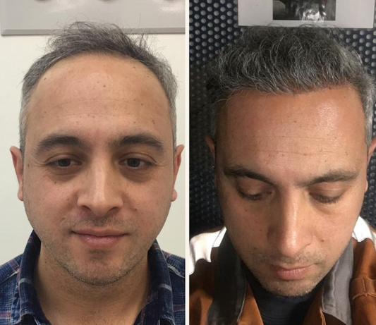 Hair Transplant